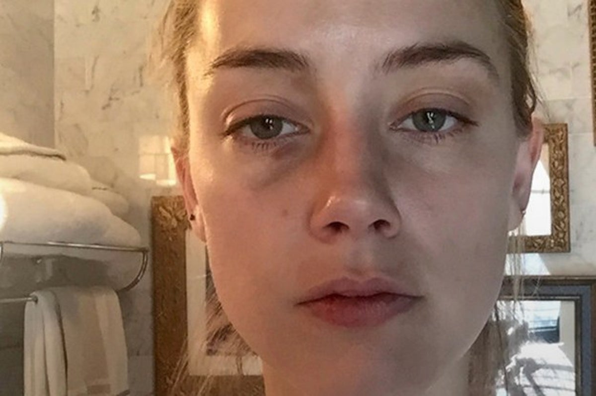 New Photos Show Amber Heard With Other Injuries Allegedly Caused By