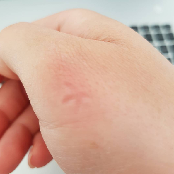 we-asked-the-experts-which-mosquito-bite-hacks-actually-work-buzzfeed