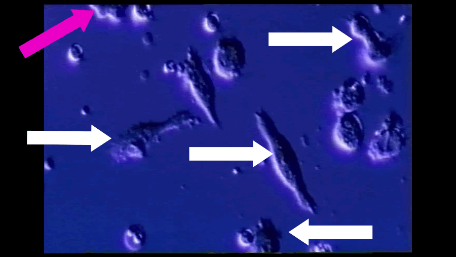 A T-cell (pink arrow), reprogrammed by immunotherapy, attacks and kills cancer cells (white arrows).