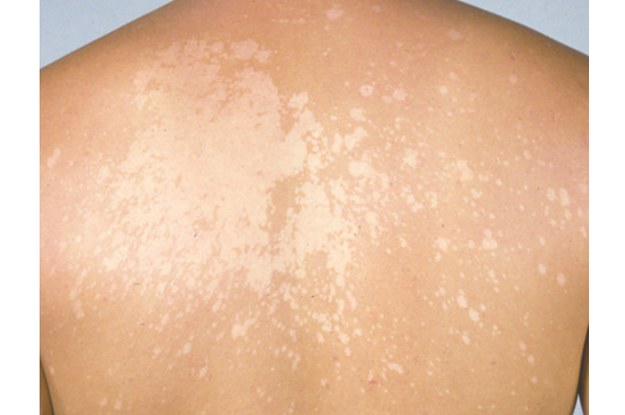 This Skin Fungus Is Super Common And You'll Probably Get 