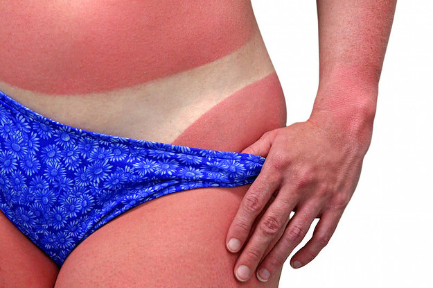 Bilderesultat for worst sunburn