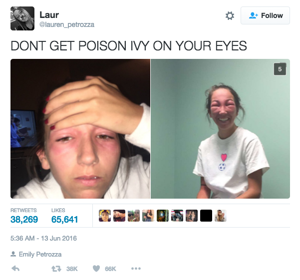 Like this girl, who is very allergic to poison ivy and also got it on her eyes.