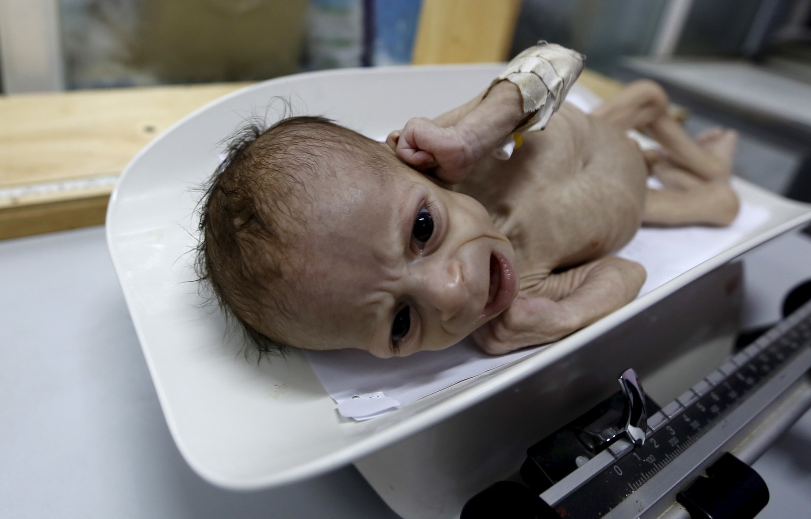 栄養失調で弱る子供たち イエメンで起きていること