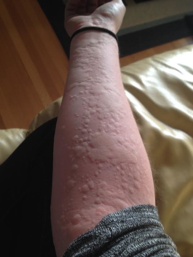 31 Allergic Reactions That Actually Hurt To Look At