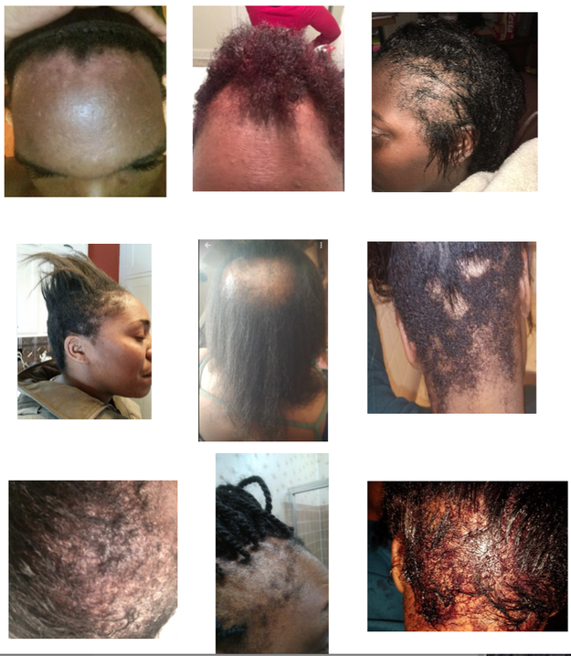 On Monday, the law firm released photos from some of its clients who claim to have been harmed by the relaxer.