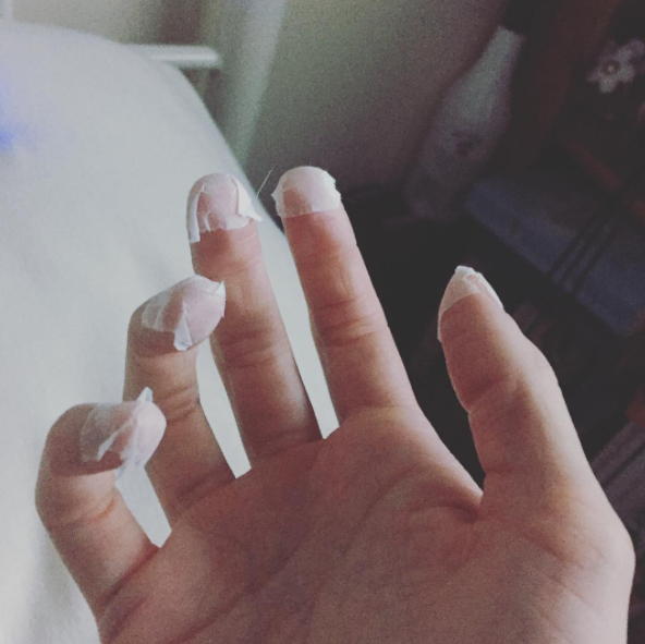 28 People Share How They Keep From Picking Their Skin