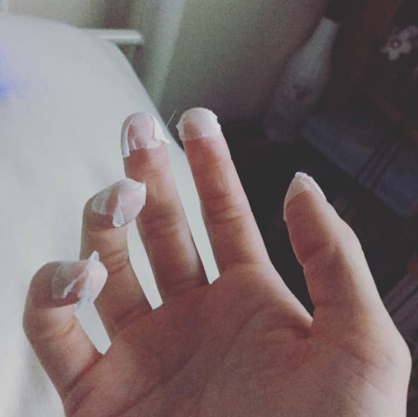 Nail Picking Disorder Nail Ftempo