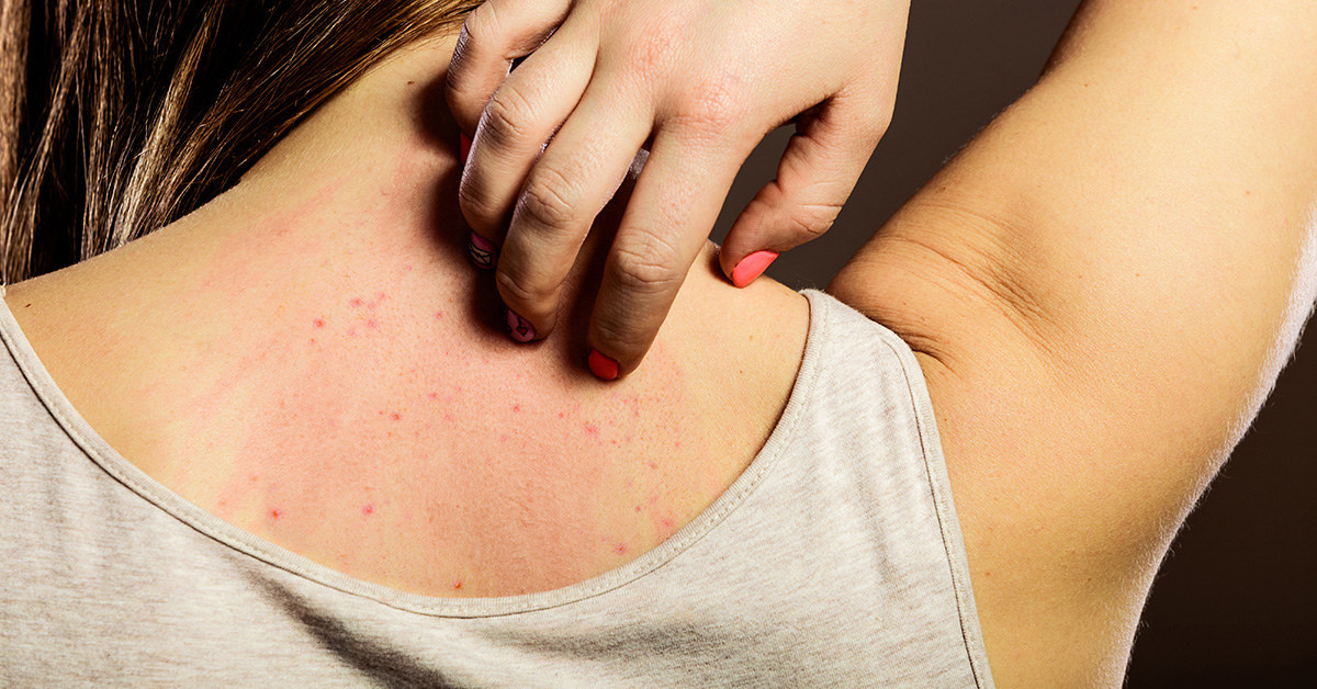 Approximately 80% of all dermatitis incidents are the result of contact with skin irritants that the individual is not actually allergic to. However, in 10% – 20% of dermatitis cases incidents are brought on as a direct result of severe allergic reactions. While this number is far less substantial than non-allergic dermatitis, the billions of dollars spent on healthcare and lost workdays makes it significant both economically and personally.
