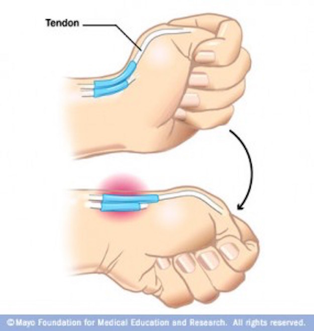 tendons in your thumb