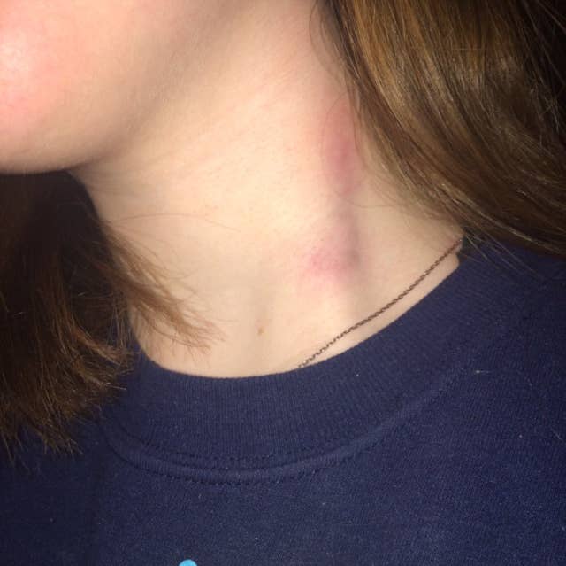 Burnt Carpet With Hair Straighteners Carpet Vidalondon