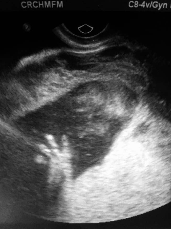 The ultrasound showed a bubble on Omara's neck, which she said doctors believed was a rare tumor called a 'teratoma' but wouldn't know more until they did an MRI. 'The doctor told us it was in our best interest to terminate the pregnancy because her dying was pretty inevitable ... but we didn't want our baby to die ... we wanted to give Omara a fighting chance,' Paradiso wrote in her blog.