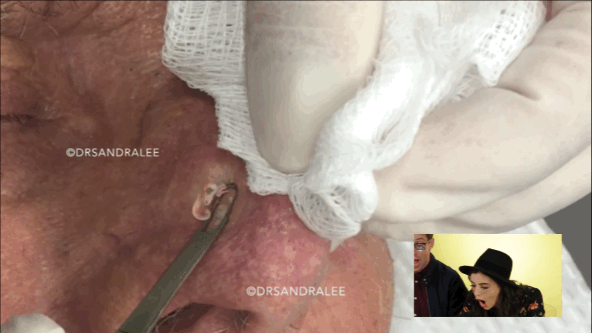 Old noses are full of stuff. Thanks, Dr. Pimple Popper!