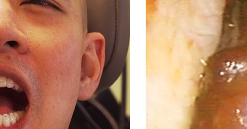 耳鼻科で本気の耳掃除に行ってみたら耳垢がごっそりとれた