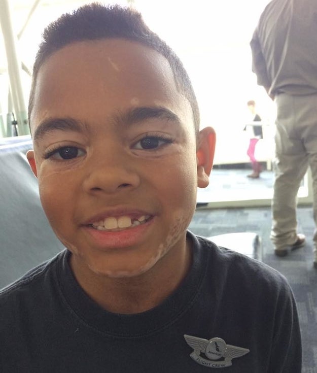 And so does 8-year-old Carter Blanchard, who lives in Arkansas. Vitiligo is a benign condition which causes loss of skin pigment.