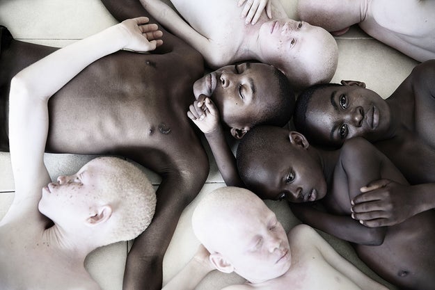 "Powerful Pictures Of Albino Children Highlight Disturbing Murders In Tanzania" — Metro