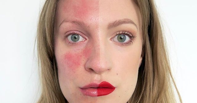 11 Things People With Rosacea Should Know