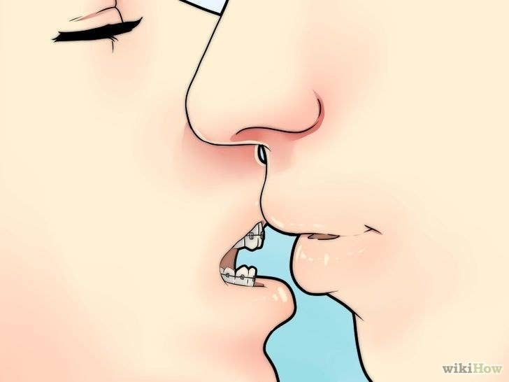 19 Struggles Only Former Brace Faces Will Get