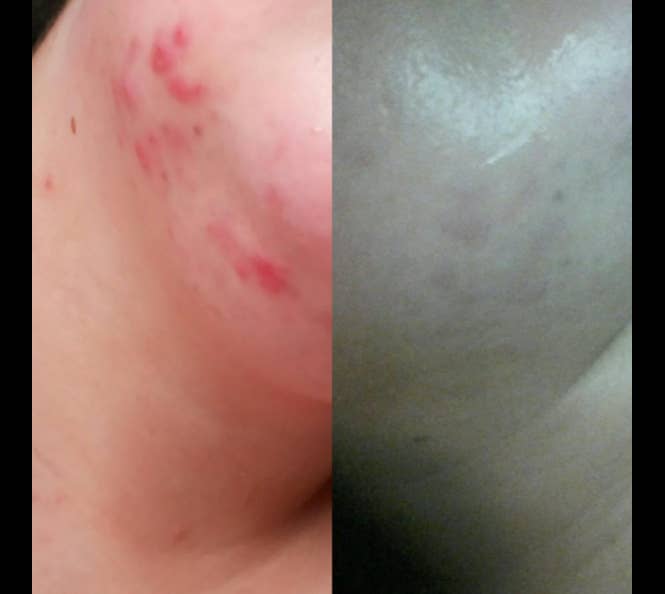 7 Gross But Satisfying Products That Will Get Rid Of Ingrown Hair