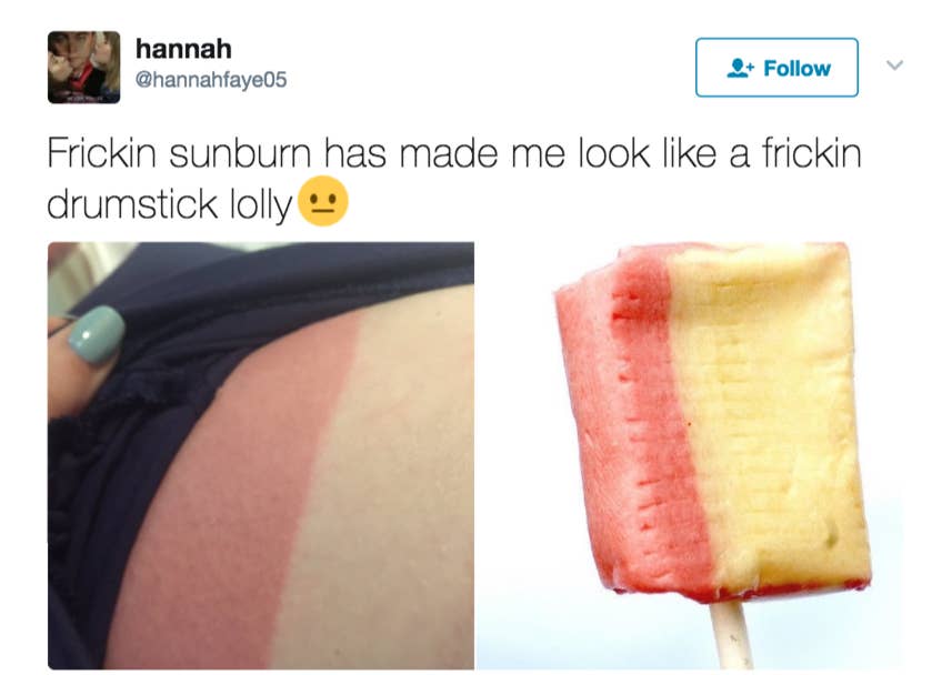 Drumstick squashies sunburn