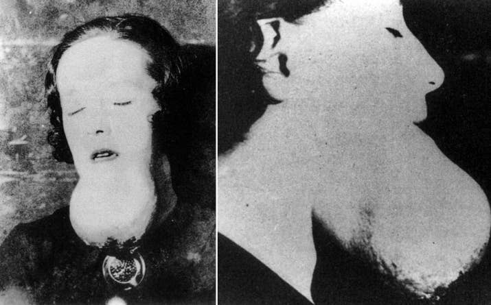 ラジウムで顎に肉腫ができた文字盤塗装の女工。正面と横からの写真。