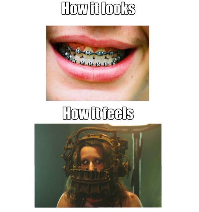 23 Pictures That Will Send Chills Down Your Spine If You Had Braces