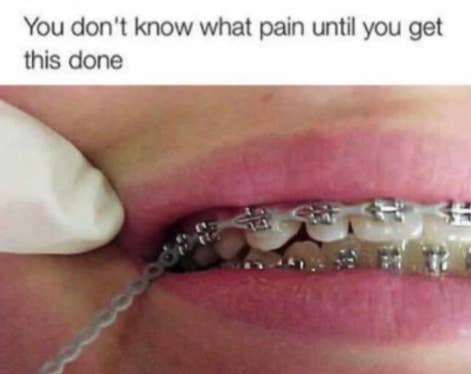 23 Pictures That Will Send Chills Down Your Spine If You Had Braces Polls surveys questions scored quizzes personality quizzes search in: 23 pictures that will send chills down