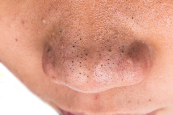 Here's What You Should Know Before Using Pore Strips