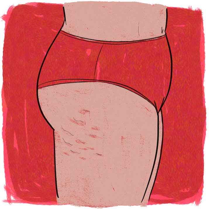 Don't let anyone make you think your cellulite is unsightly or ugly! It's just a normal part of your body, dammit!