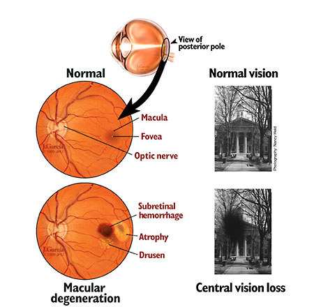 Because the eye filters so little blue light, virtually all of it reaches the retina. It’s thought that the high-energy light may contribute to the gradual damage and degeneration of light-sensitive cells in the retina. Macular degeneration is a cause of vision loss that can even reach the point of blindness that is usually age-related. With growing numbers of young people spending so many hours with bright screens, there is cause for concern about the long-term effects of blue light.