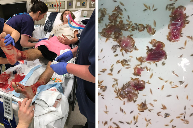An Australian Teenager's Legs Were Eaten By Sea Fleas And 