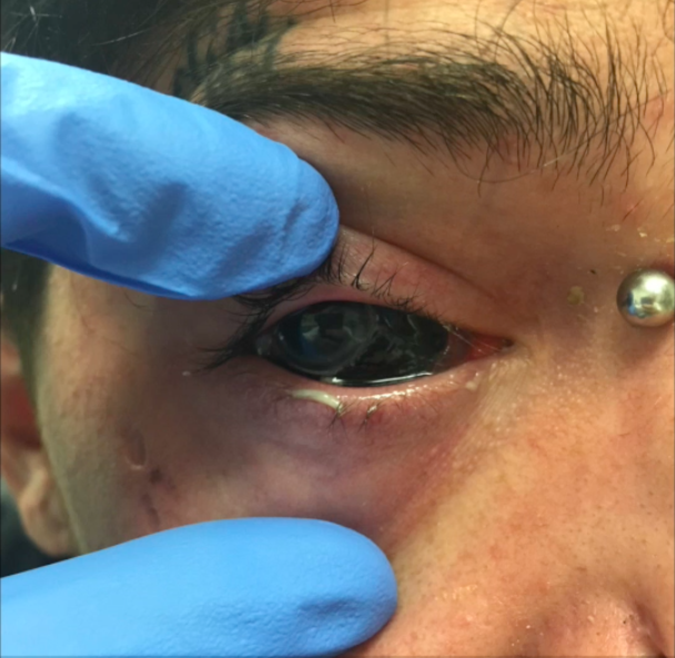 Woman, 21, blinded in both eyes by tattoo artist in botched attempt to dye  her eyeballs black like rap star | The US Sun