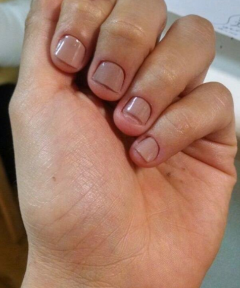 15 Practical Tips To Help You Quit Biting Your Nails - 