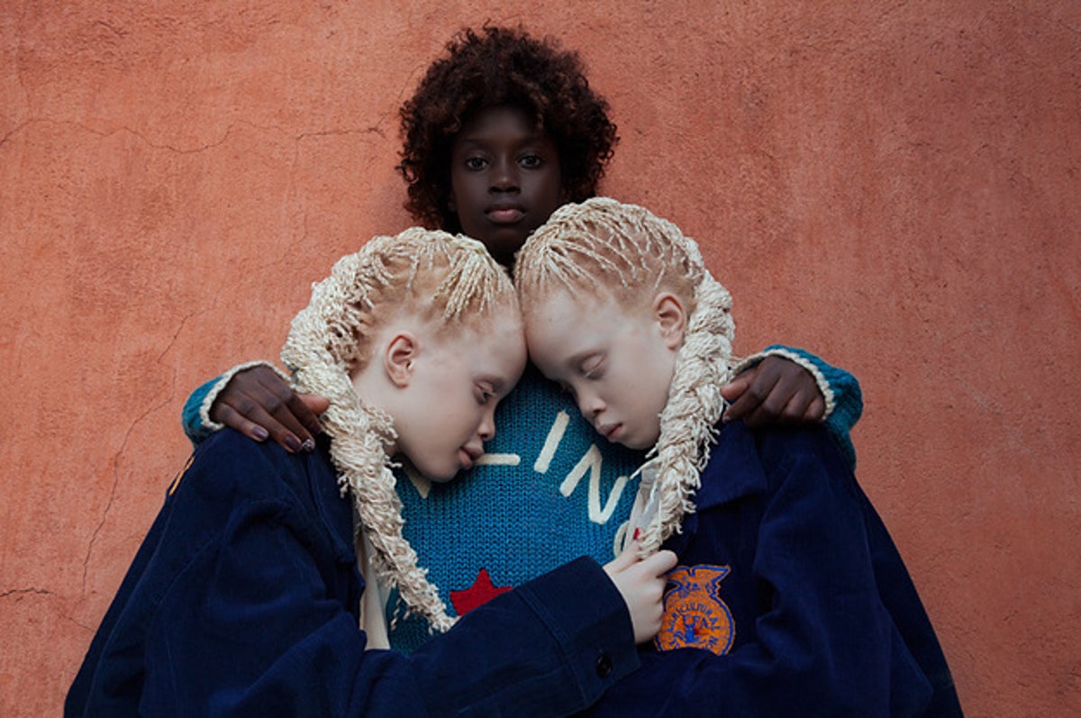 Albino Twins