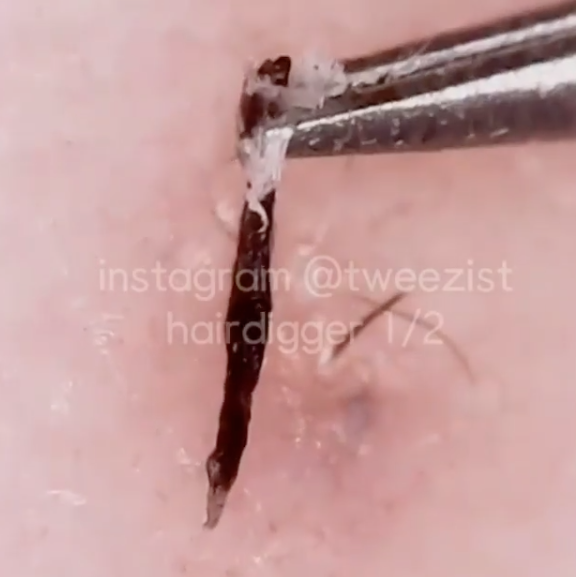 Welcome to the Instagram account Tweezist. It's full of ingrown hairs being plucked out in mega, mega, close up.