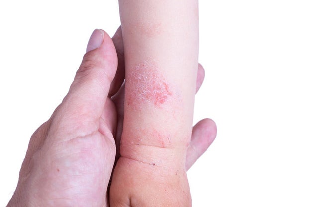 Eczema is a chronic skin condition that causes red, itchy, inflamed patches on the skin.