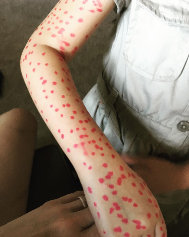 This child who decided to give herself chicken pox.