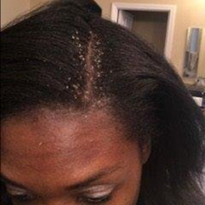 A reviewer's head with lots of dandruff flakes around their part