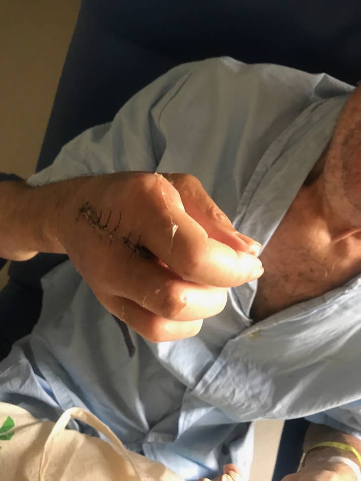 Sua mão direita, que teve o dedo médio amputado, no domingo de Páscoa, 16 de abril.