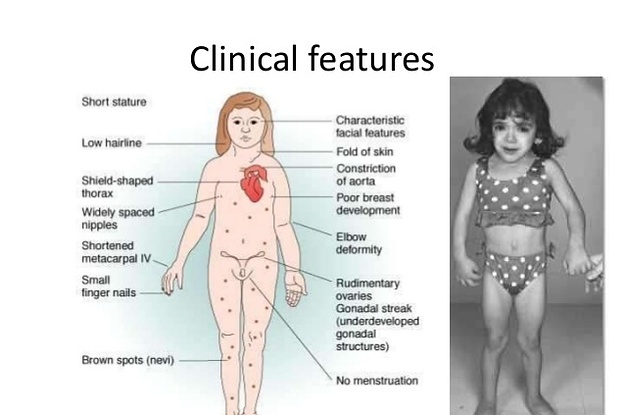 What Is Turner Syndrome Causes Symptoms And Treatment