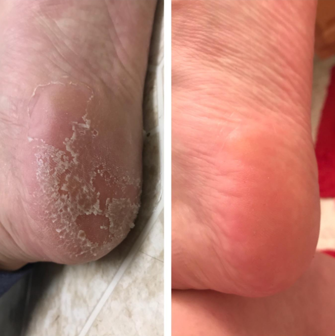 Get Amazingly Gross Results With This Internet-Famous Foot Peel