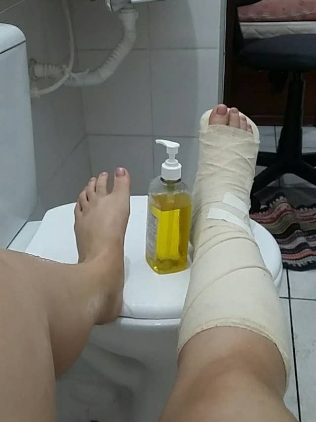 14 Things Burned Into The Memory Of Anyone Who S Broken A Bone Before