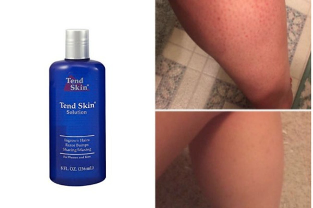 Tendskin is in Kenya.Have you suffered from bumps after waxing