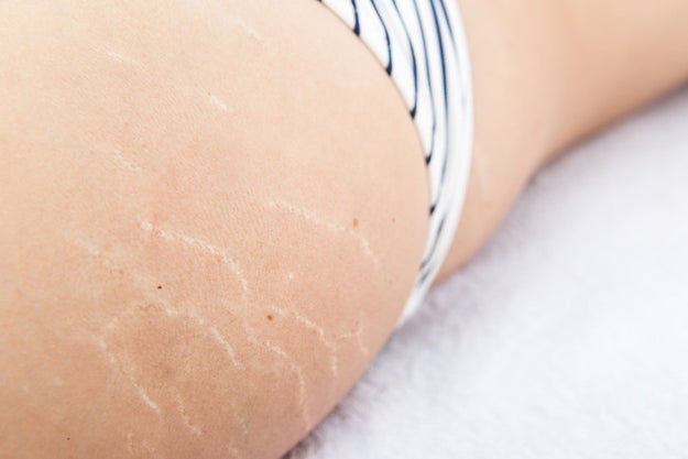 People get stretch marks for all kinds of reasons — and they come in all different shapes and sizes.