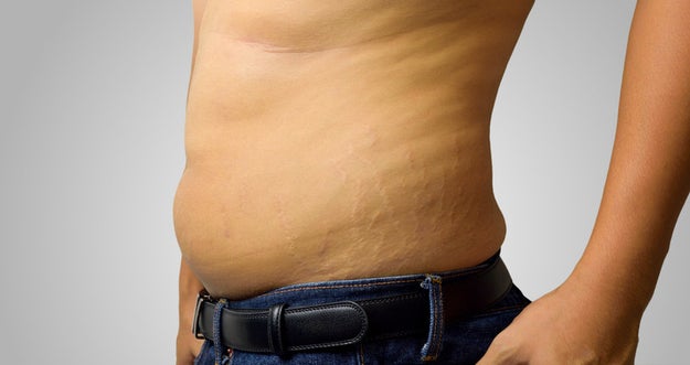 Or perhaps you just want to explain that literally anyone can get stretch marks, not just moms during pregnancy.