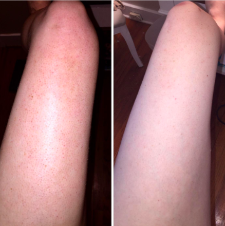 keratosis pilaris treatment before and after