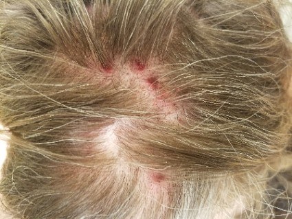 scalp scabs picking