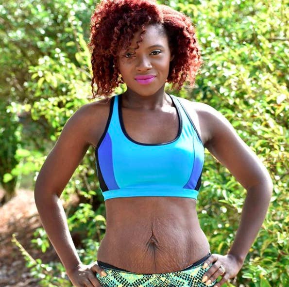 Women Are Sharing a Talk On Body Positivity By Posting Pics Of Their Stretch Marks