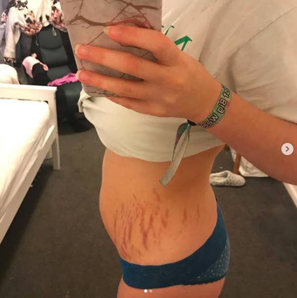 Women Are Sharing a Talk On Body Positivity By Posting Pics Of Their Stretch Marks