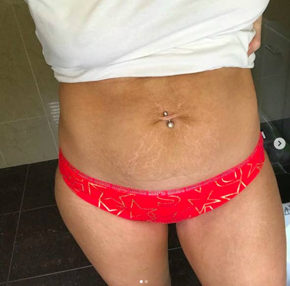 Women Are Sharing a Talk On Body Positivity By Posting Pics Of Their Stretch Marks