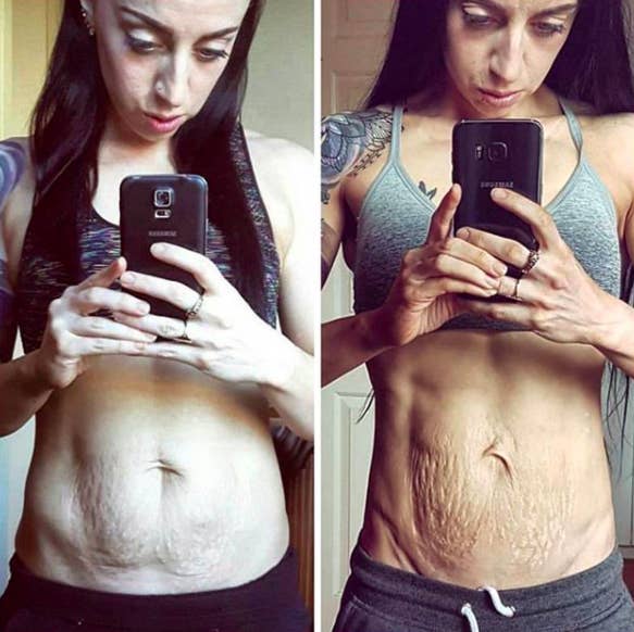 Women Are Sharing a Talk On Body Positivity By Posting Pics Of Their Stretch Marks